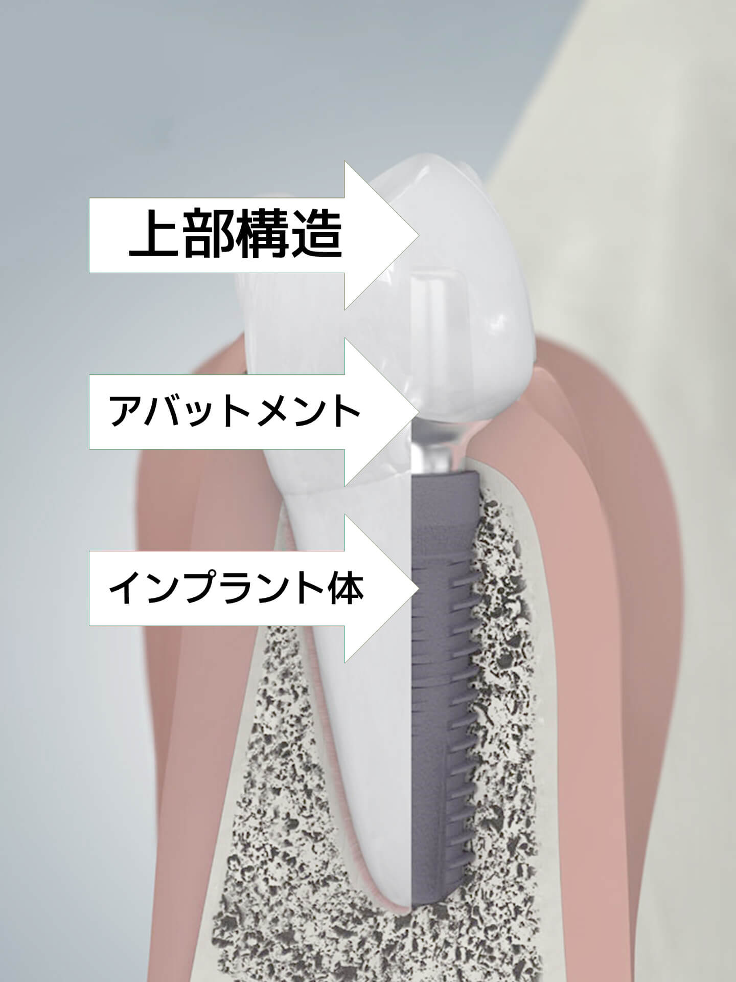 インプラントの構造と素材
