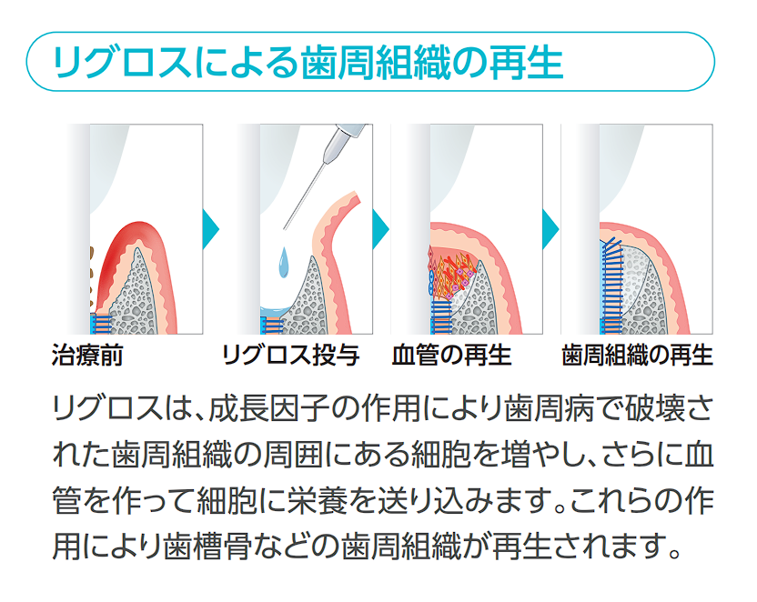 歯周病治療