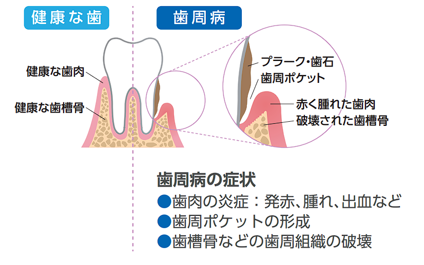 歯周病の原因